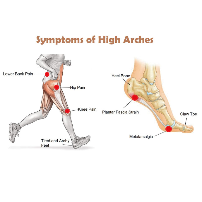 How to Choose Orthotic Insoles for High Arches