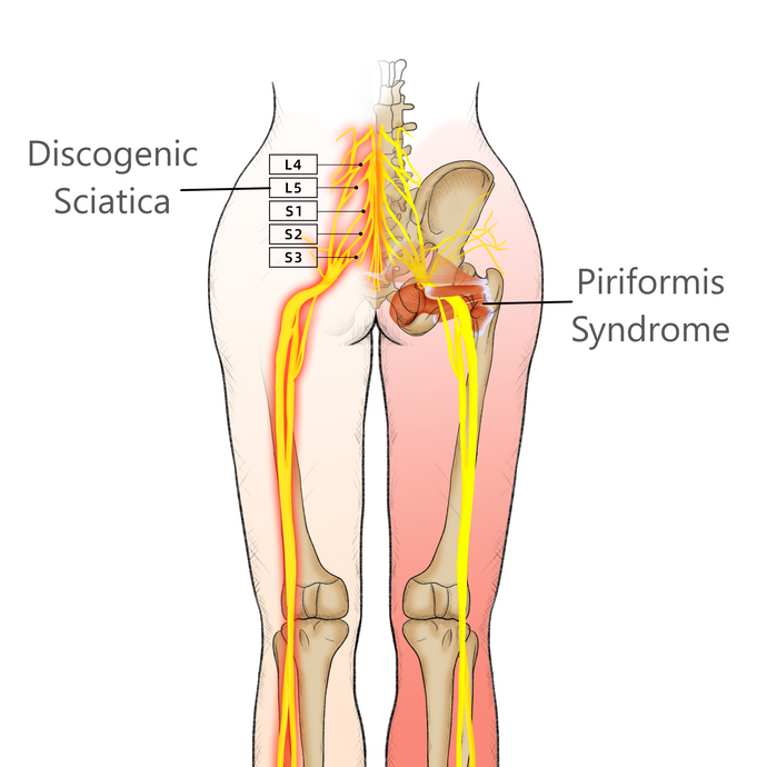 How To Relieve Sciatica, Piriformis Syndrome