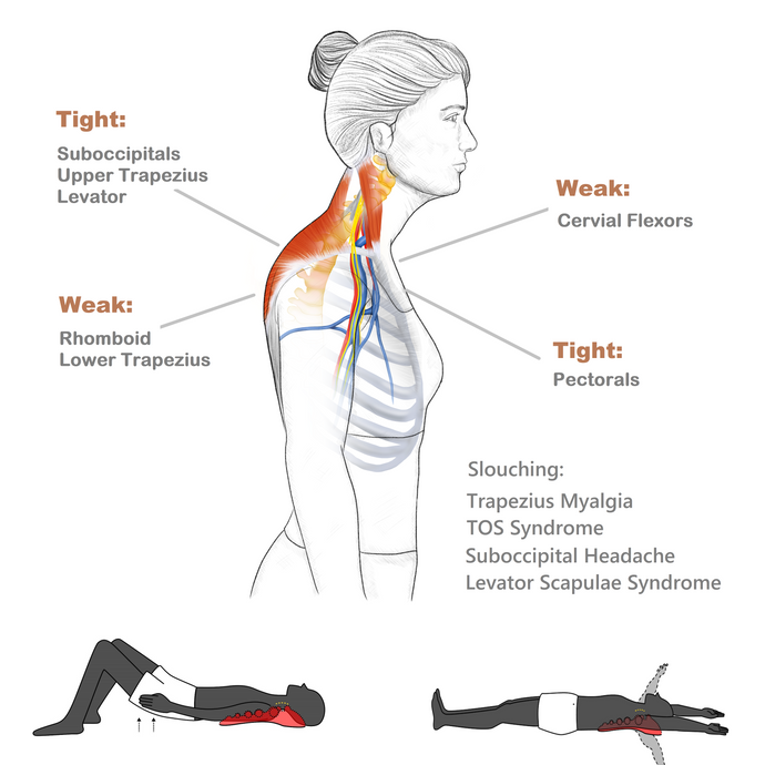 How to Relieve Thoracic Outlet Syndrome Pain