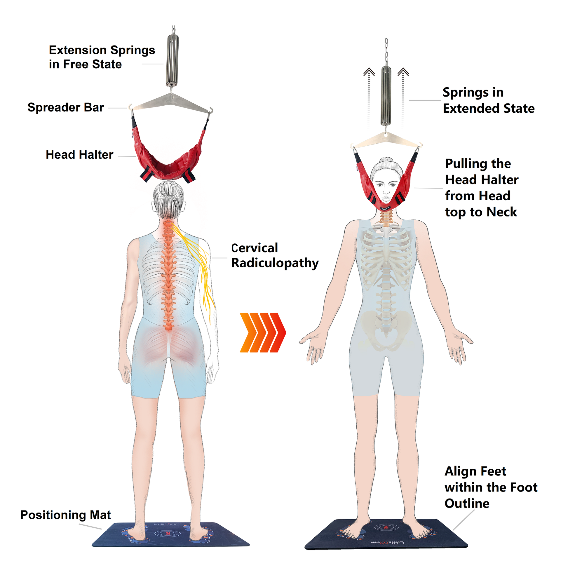 cervical radiculopathy relief